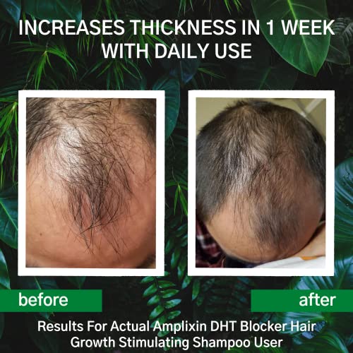 Shampoo de crescimento de cabelo do DHT Blocker | Tratamento clinicamente comprovado de perda de cabelo e regenharia